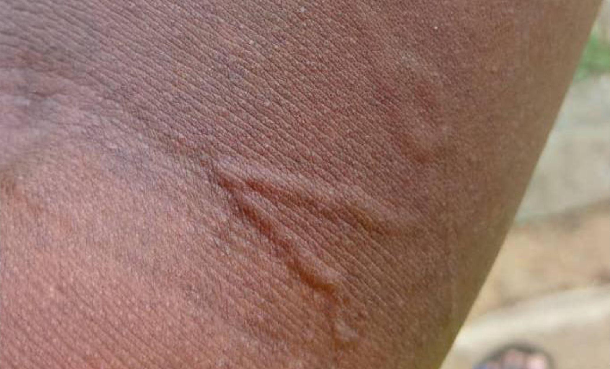 Visible wormlike swelling underneath the skin on an arm